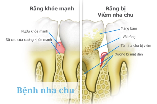 Sự khác biệt giữa răng bị nha chu và hàm răng khỏe mạnh